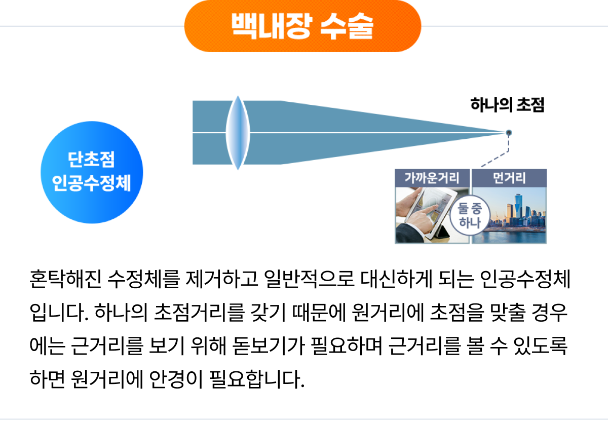 백내장 수술