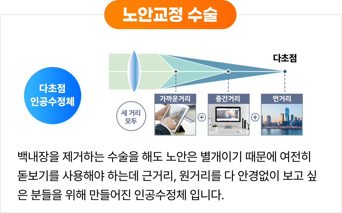 노안교정 수술