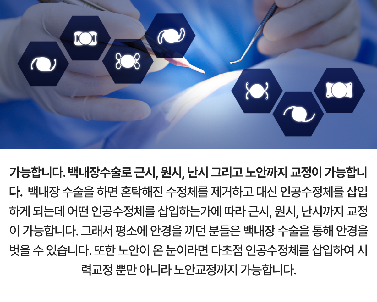 백내장의 진행상태, 환자의 눈의 상태, 일상생활에서 불편함의 정도