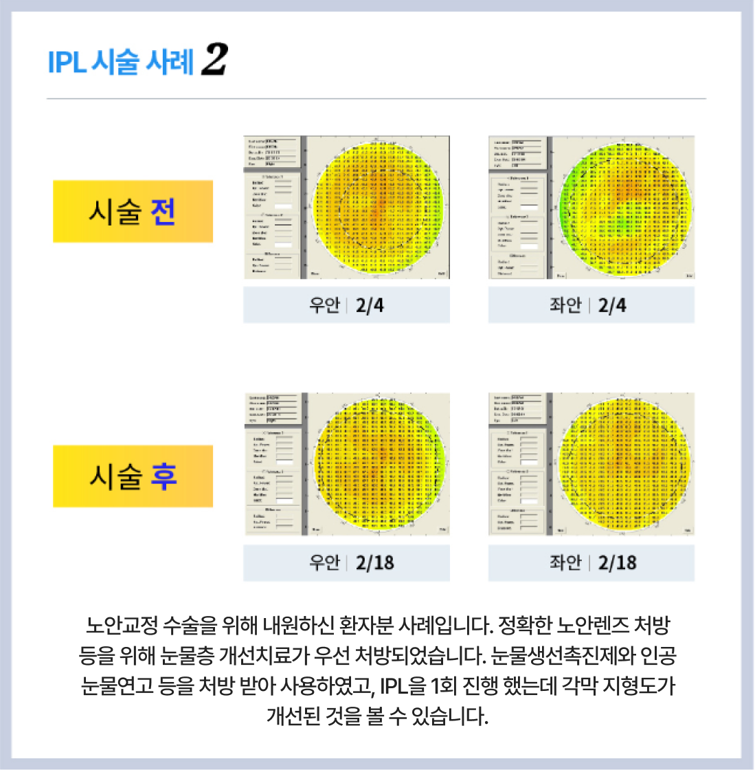 시술사례2