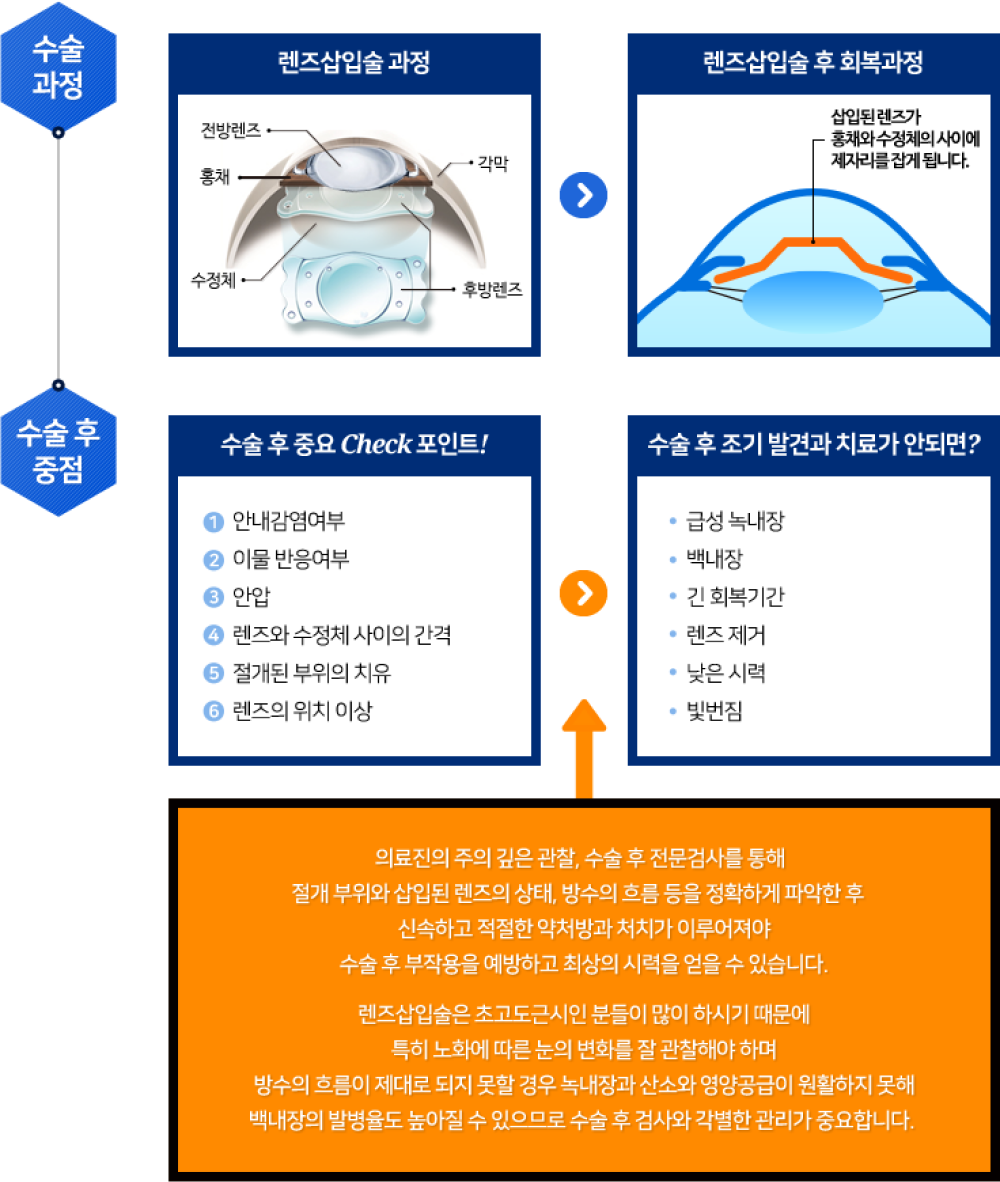 렌즈삽입술