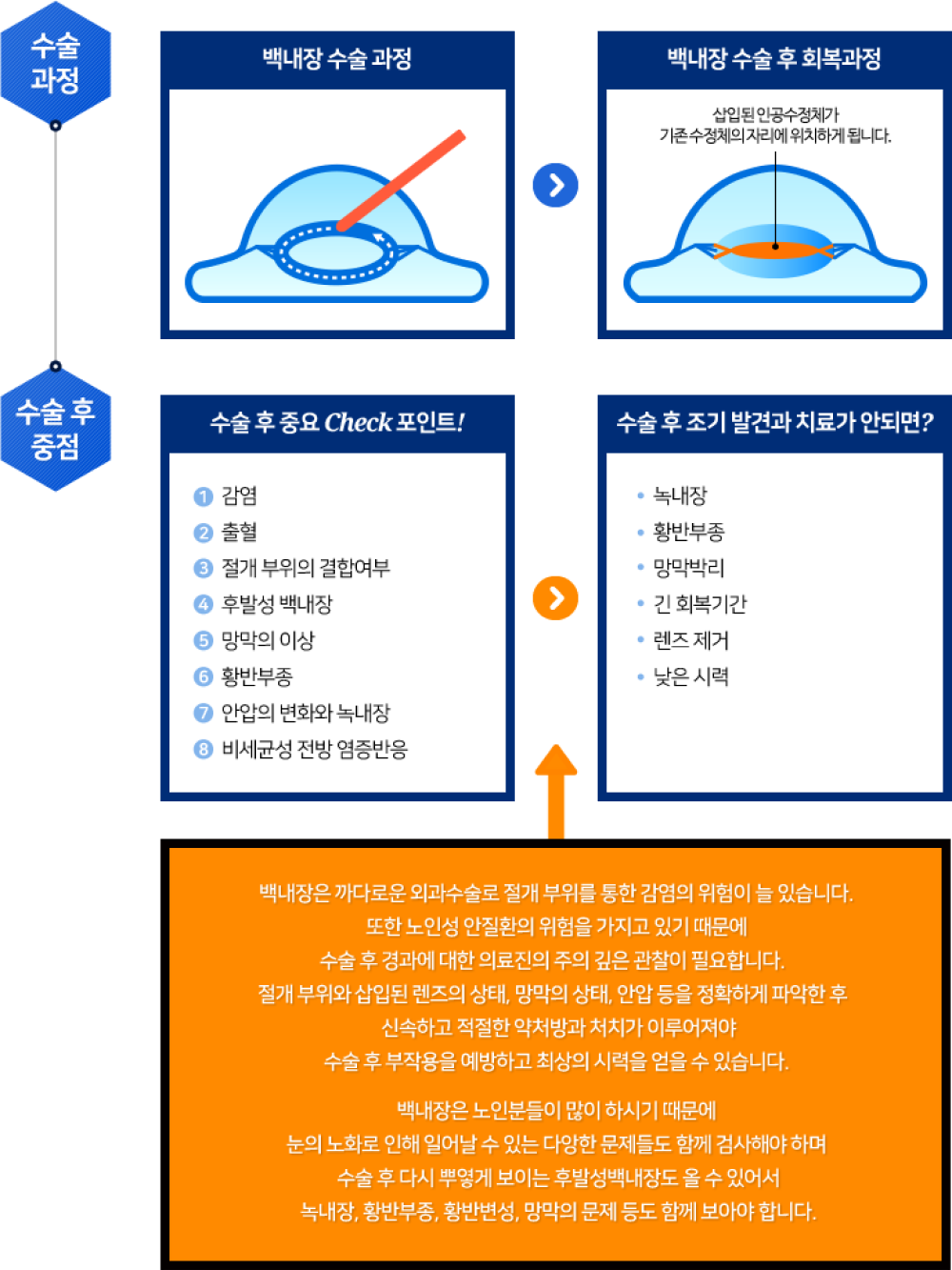 백내장 수술