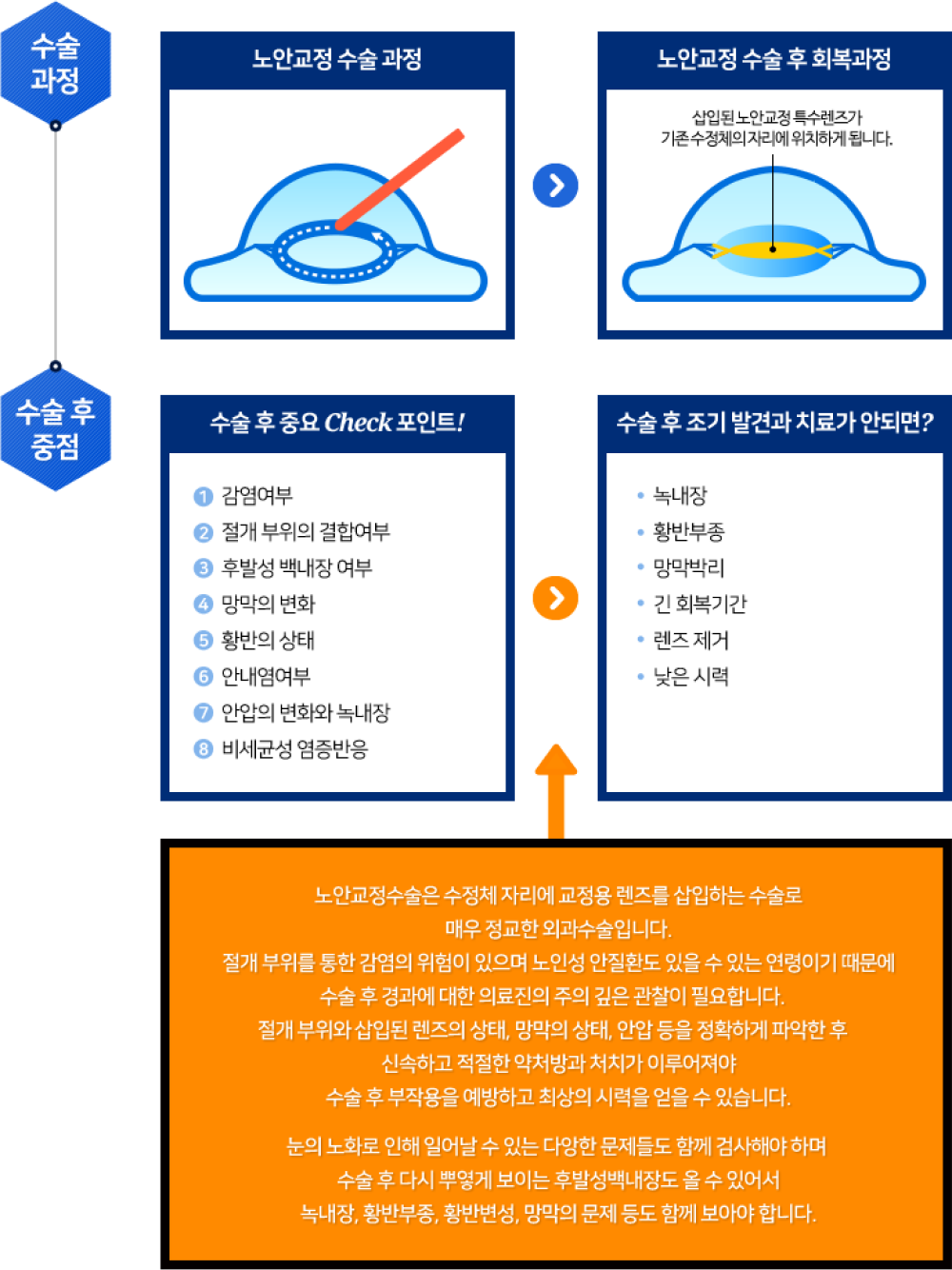 노안교정 수술
