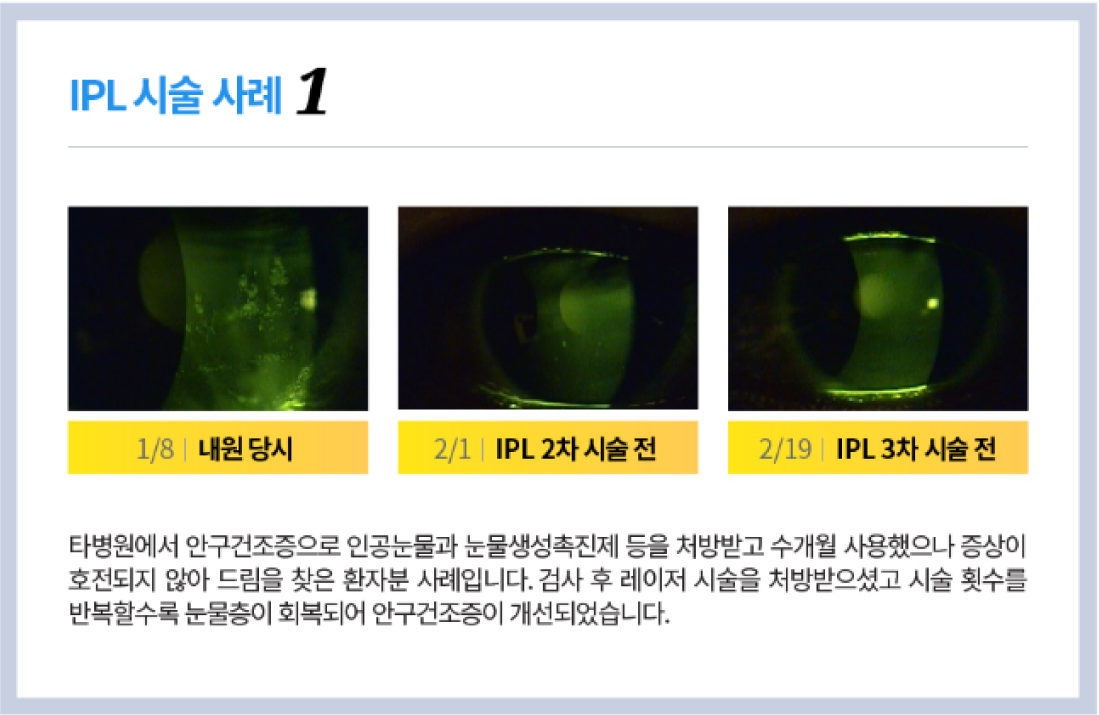시술사례1