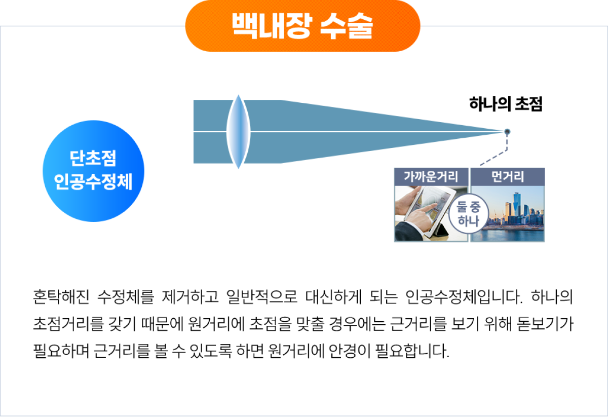 백내장 수술