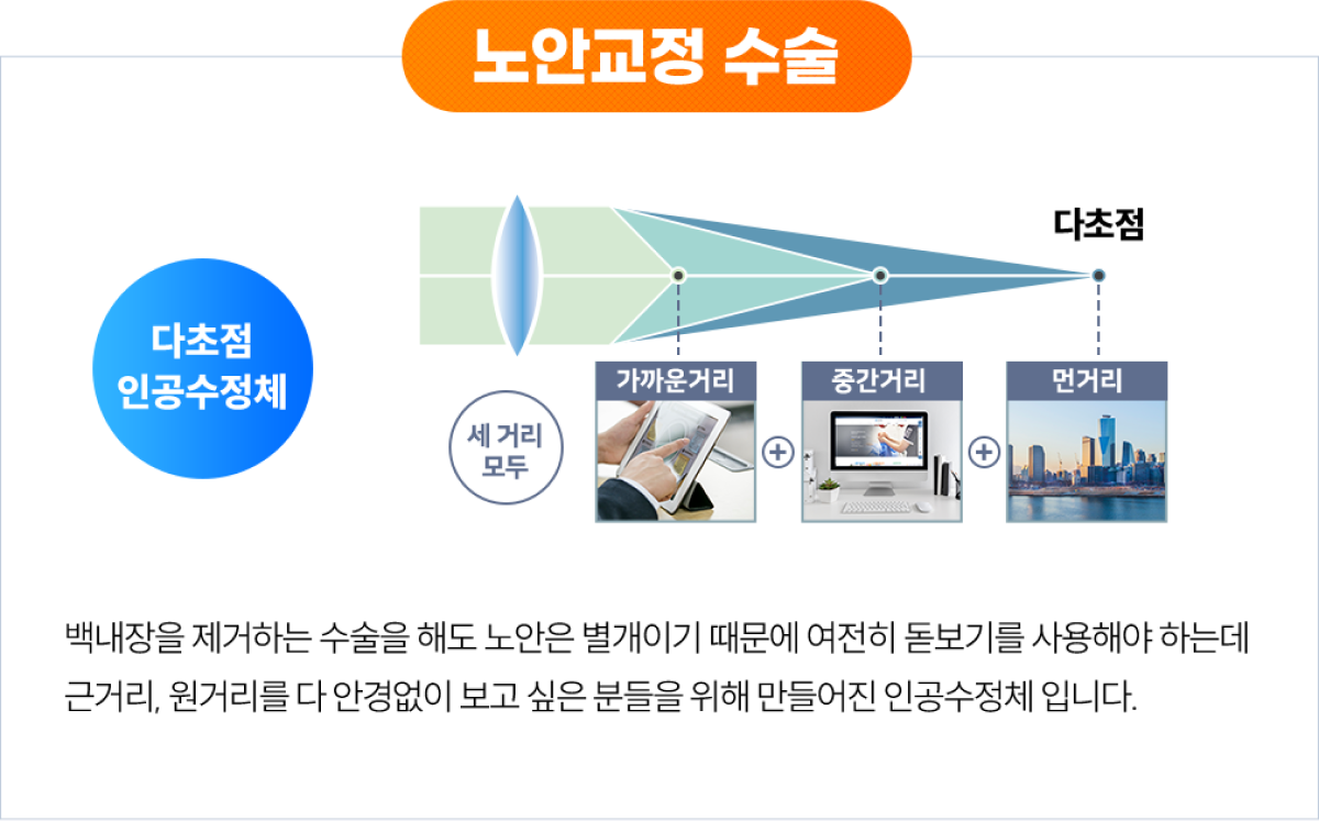 노안교정 수술