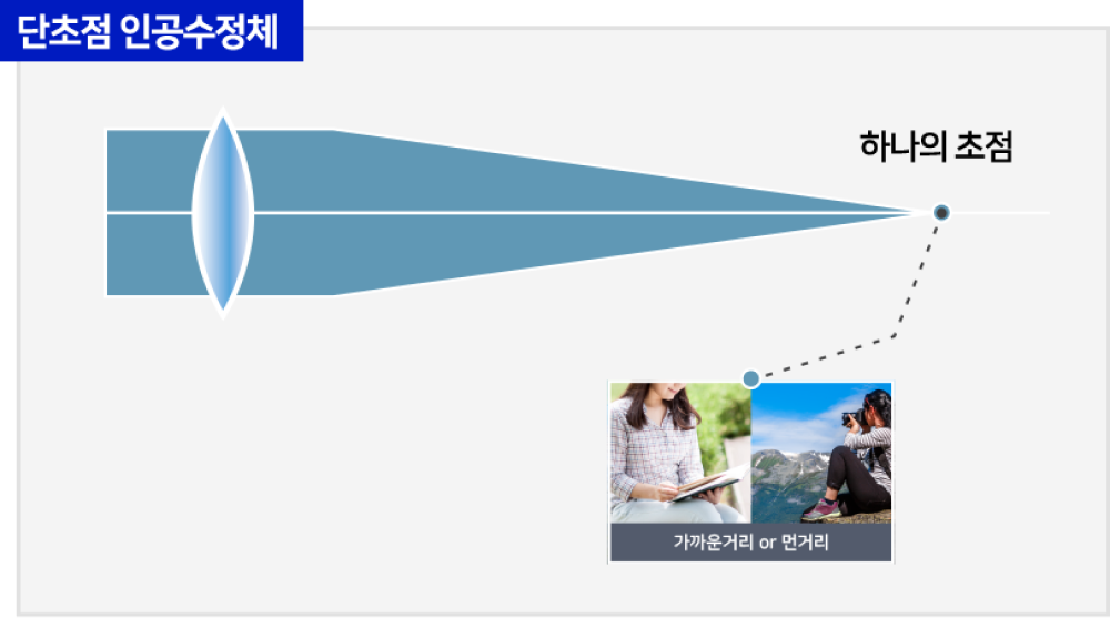 단초점 인공수정체
