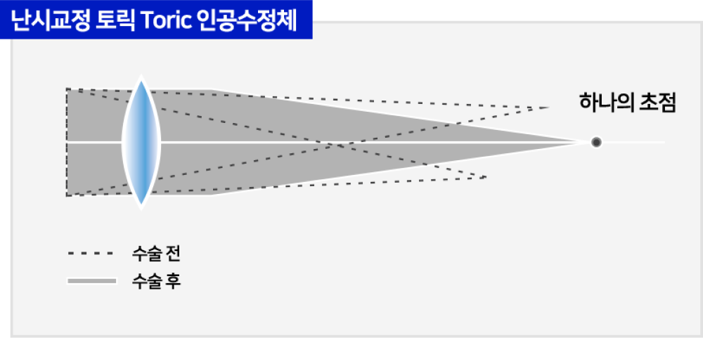 난시교정 토릭 Toric 인공수정체