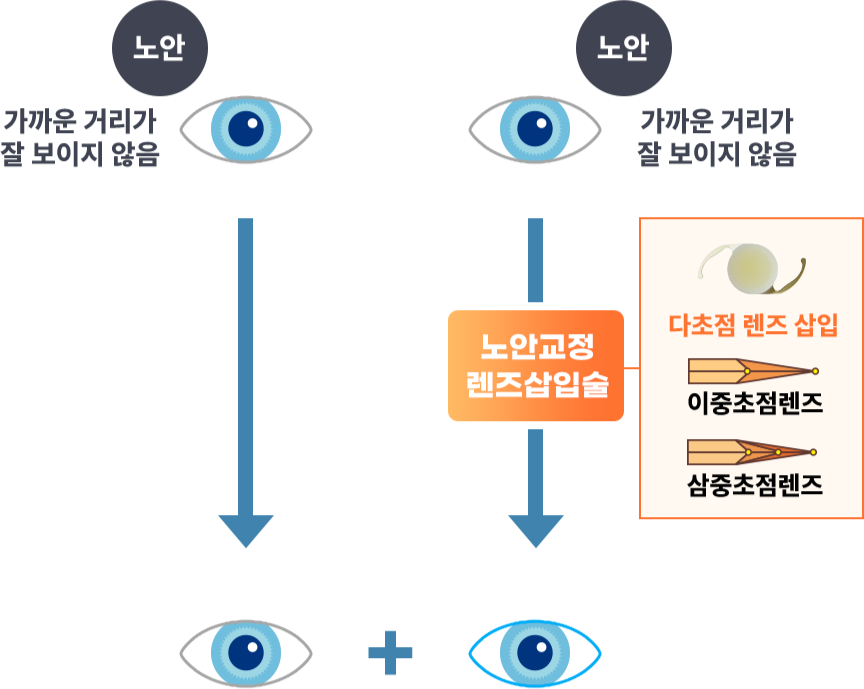 노안