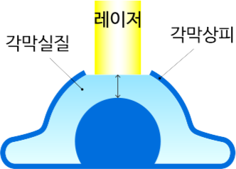 각막실질, 레이저, 각막상피