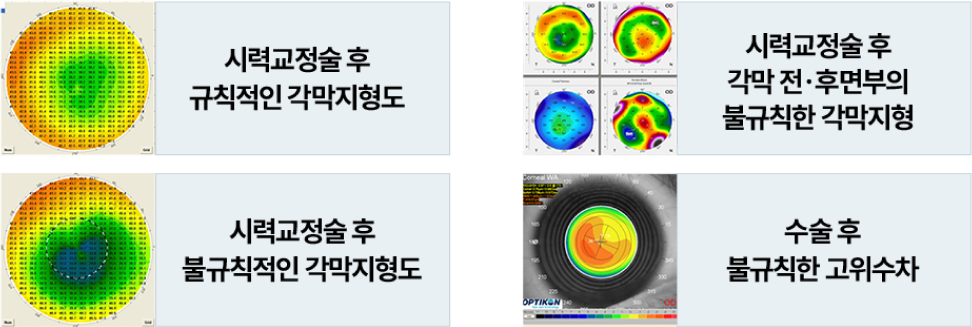 각막표면이 균일하지않아 번짐현상이 있을수있습니다.