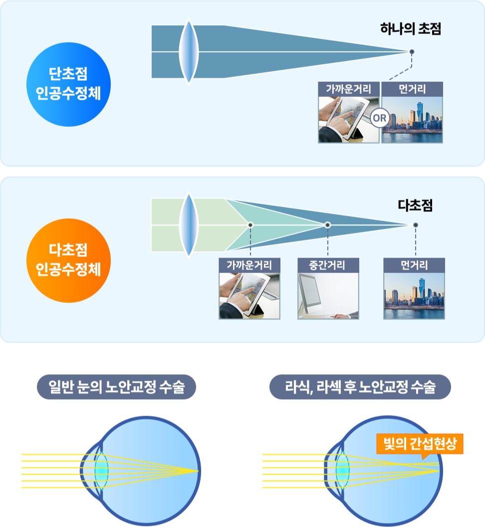각막실질, 레이저, 각막상피