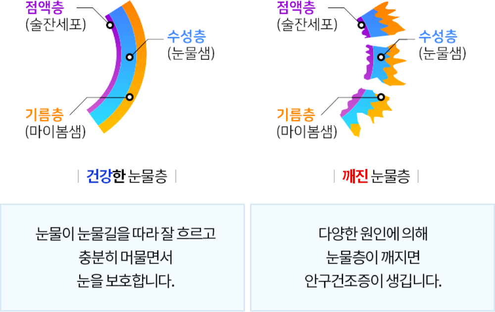 건강한 눈물층, 깨진 눈물층 그림