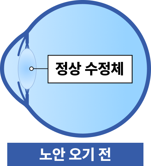 정상 수정체