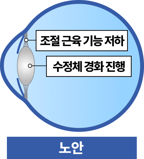수정체 혼탁
