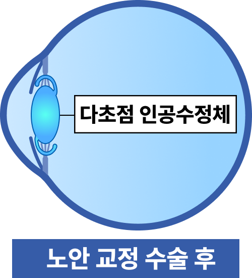 인공 수정체