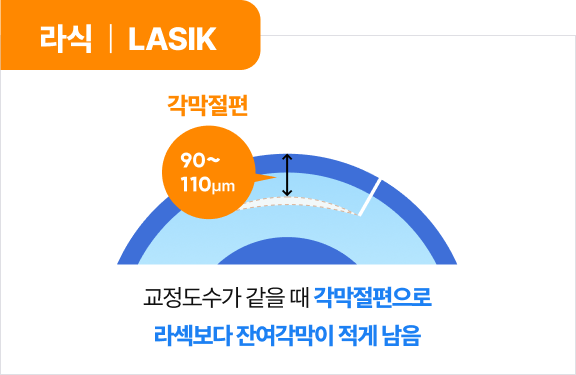 라식 | LASIK