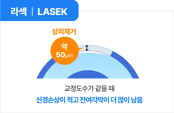 라섹 | LASEK
