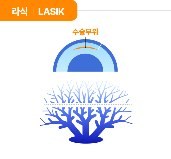 라식 | LASIK