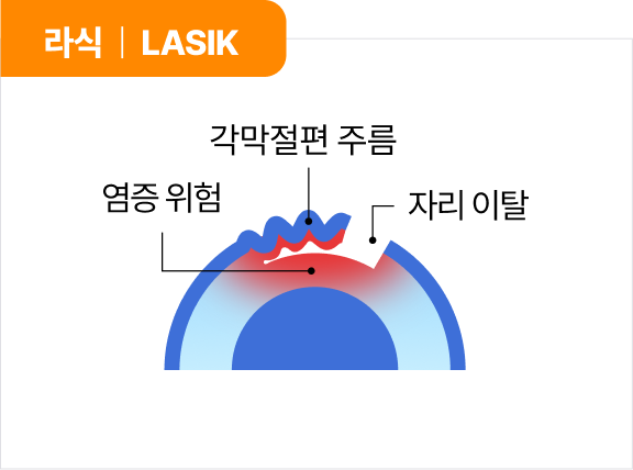 라식 | LASIK