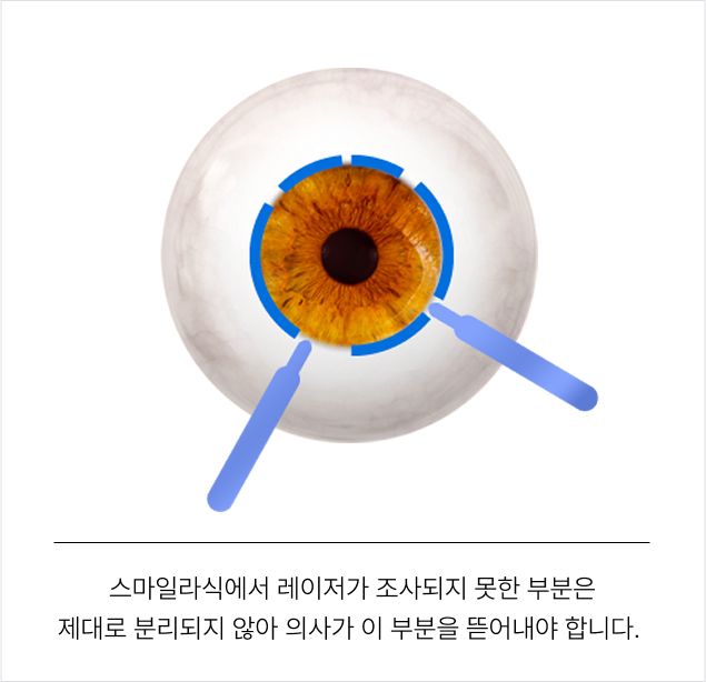 스마일라식에서 레이저가 조사되지 못한 부분은 제대로 분리되지 않아 의사가 이 부분을 뜯어내야 합니다.