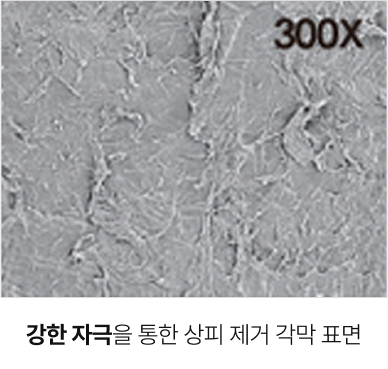 강한 자극을 통한 상피 제거 각막 표면