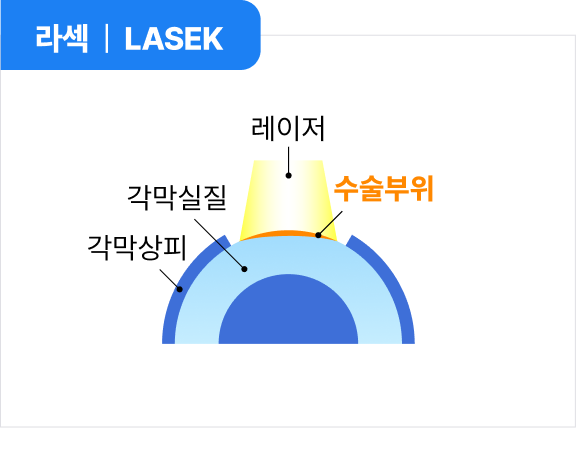라섹 | LASEK